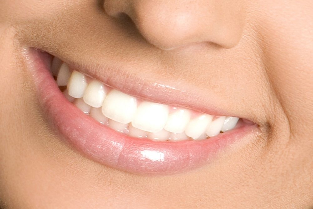 blanqueamiento-dental-en-cullera2