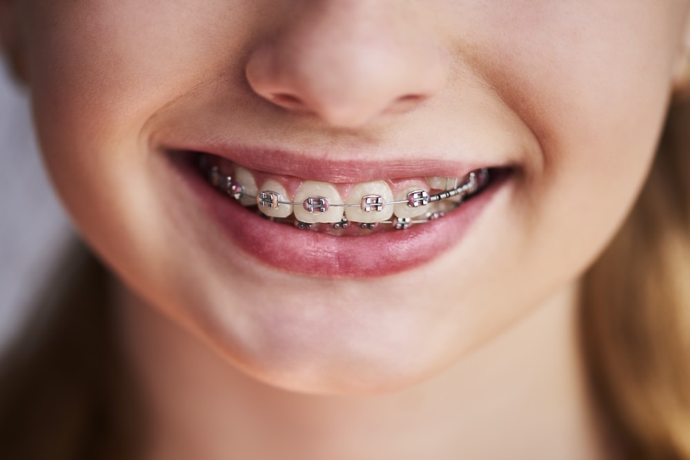 brackets-en-cullera2